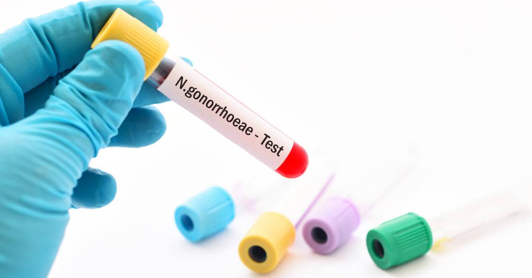 Primeiro antibiótico em décadas contra gonorreia é aprovado após décadas sem inovações