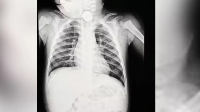 Bateria de brinquedo faz bebê de 1 ano ir parar no hospital com início de necrose em Goiânia