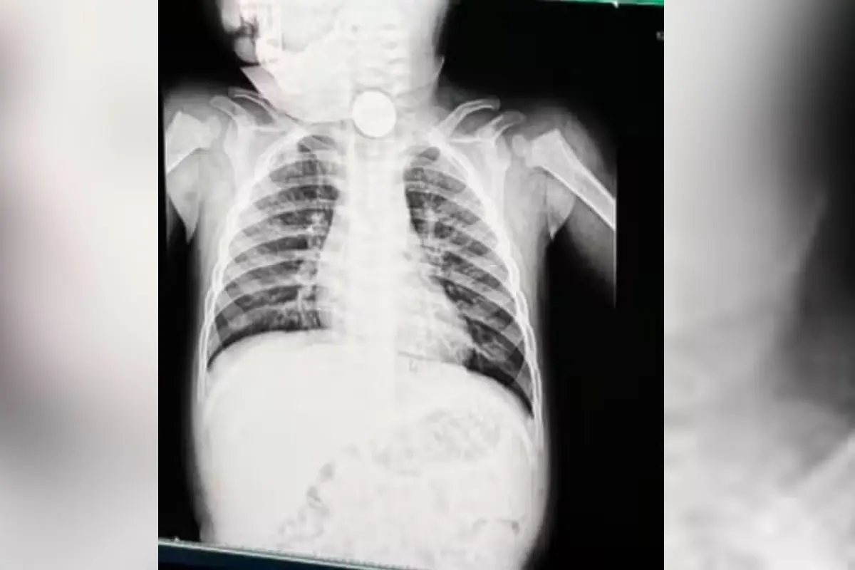 Bateria de brinquedo faz bebê de 1 ano ir parar no hospital com início de necrose em Goiânia