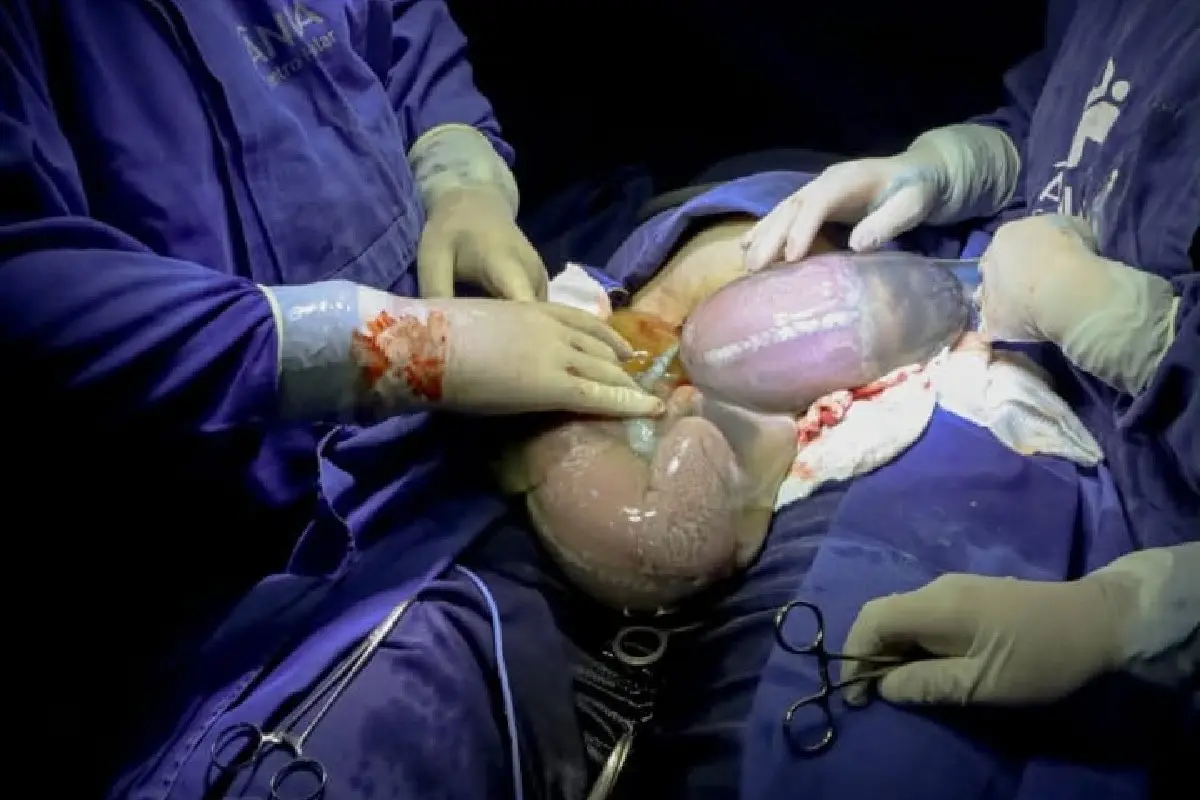 Trigêmeos nascem prematuros em Anápolis com parto raro; Dois vieram ao mundo empelicados