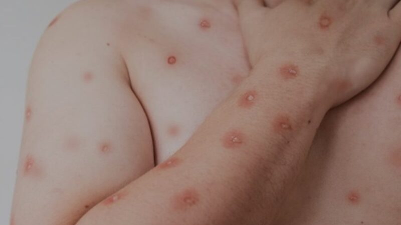 Goiás investiga cinco casos suspeitos de Mpox