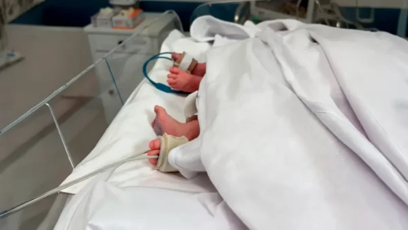 Siameses morrem após complicações infecciosas em Goiânia